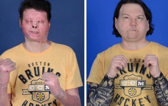 Furathama faharah moonaai ai kaamiyaabu kamaaeku transplant koffi