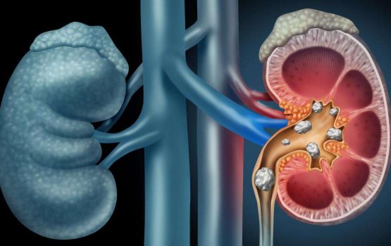 Kidneygai ufedhey hila, beyhaa nulai ves nahthaalevidhaane dhethin gotheh!