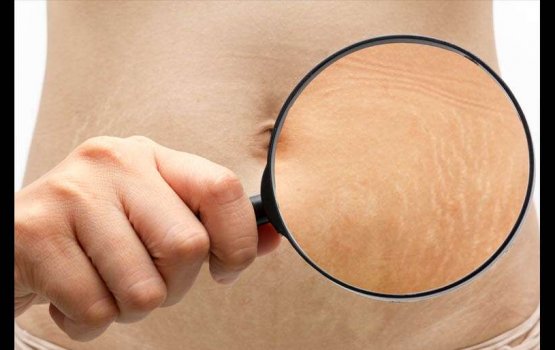 Viheumah fahu bandugai hunna stretch marks filuvaanee kihineh?