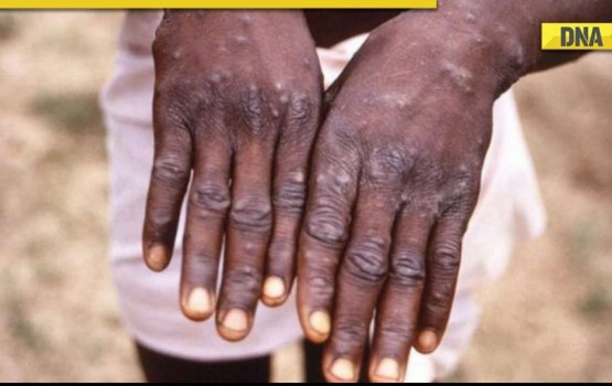 India gai Mpox jehifaivaakamah shakku kurevey meehaku ekaheri koffi