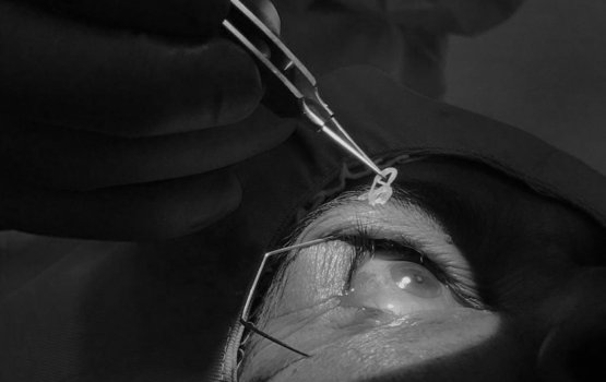 Addu Hospital in meehehge lolun African eye worm eh nagaifi 