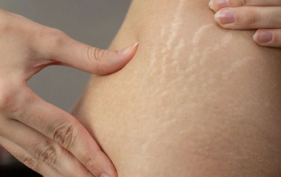 Hashigandugai hunna stretch marks filuvaalane dhethi gotheh!