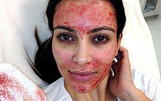 Vampire facial hedhi 3 anhenakah HIV jehijje!