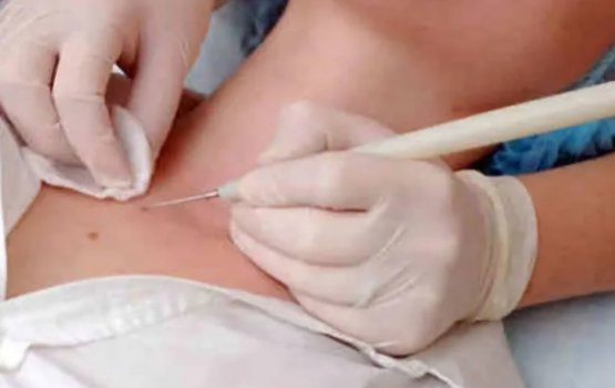 Skin Tags: Undhagoo hankolhu thakuge faruvaa faseyha!