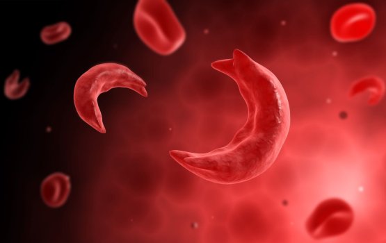 Gene therapy in sickle cell anemia ah faruva