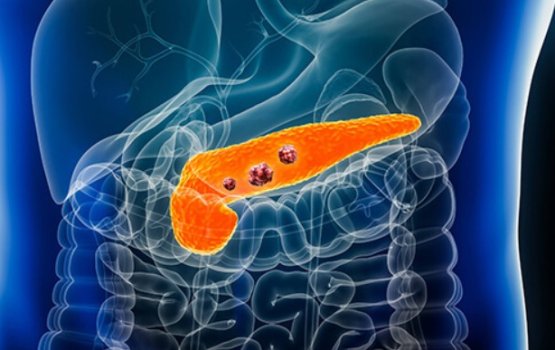 Chismey ge cancer ah kaamiyaabu faruvaa eh hoadhaifi