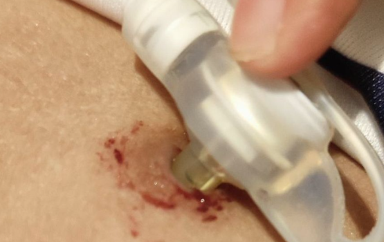 NSPA ah feeding tube eh nuhoadhi 6 aharu ge kujjaku maruvi massala balanee