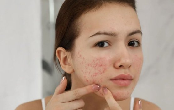 Moonugai oshaalha nagan medhuveri vaa aanmu baeh sababu thah!