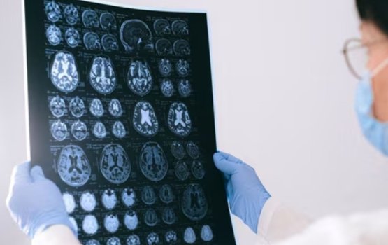 Stress kamah heekoh dhookohlevey 7 kameh: Sikundeege tumor ehge furathama alaamaai thah!