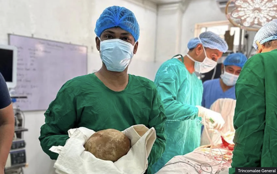 Lanka meeheh ge gain 3.1 kilo ge bladder stone eh nagai, dhuniyey ge record eh